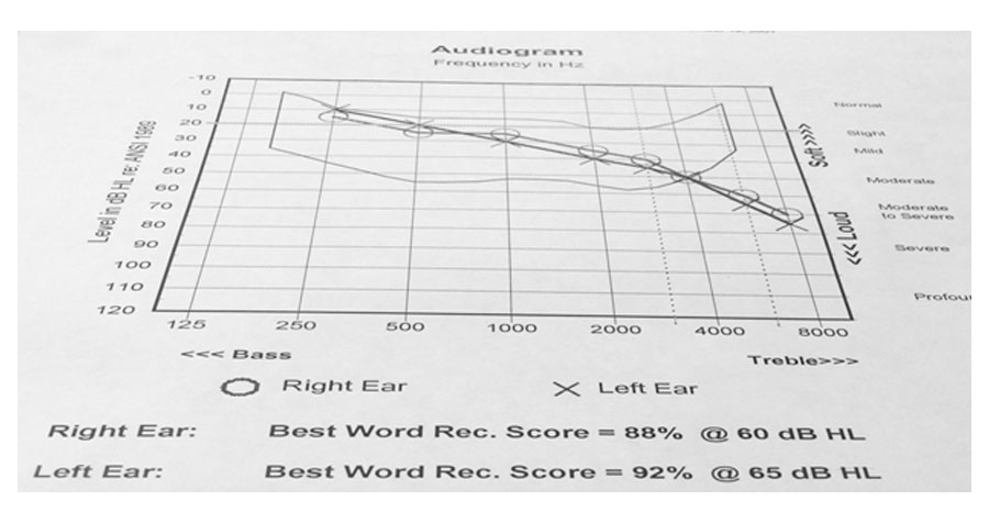 Do Hearing Aids Restore Full Hearing Ability